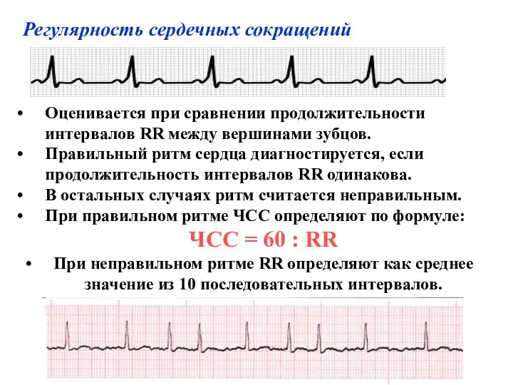 Оценивается при сравнении продолжительности интервалов RR между вершинами зубцов. Правильный