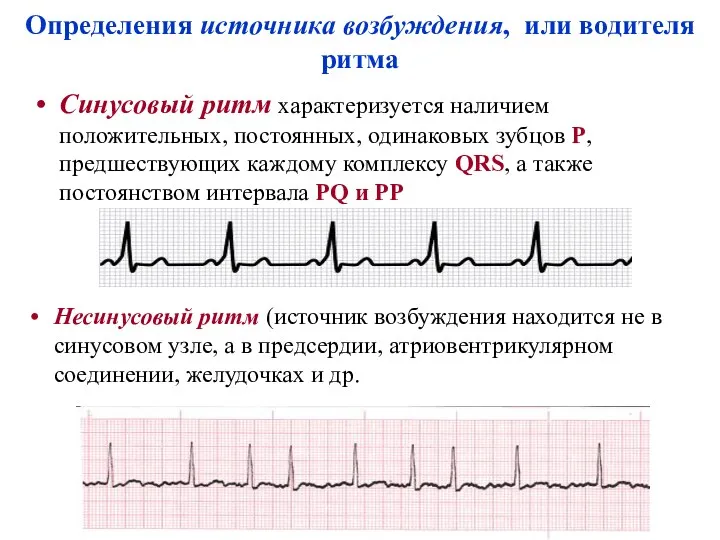 Определения источника возбуждения, или водителя ритма Синусовый ритм характеризуется наличием