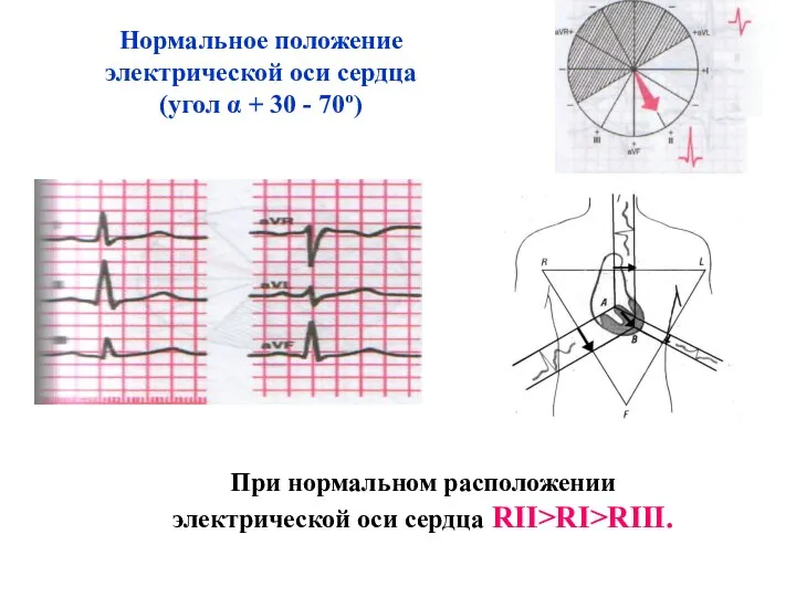 Нормальное положение электрической оси сердца (угол α + 30 -