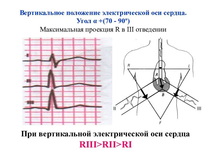 Вертикальное положение электрической оси сердца. Угол α +(70 - 90º)