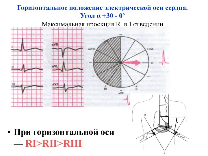 Горизонтальное положение электрической оси сердца. Угол α +30 - 0º