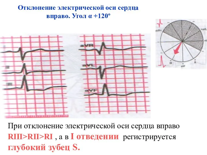 Отклонение электрической оси сердца вправо. Угол α +120º При отклонение