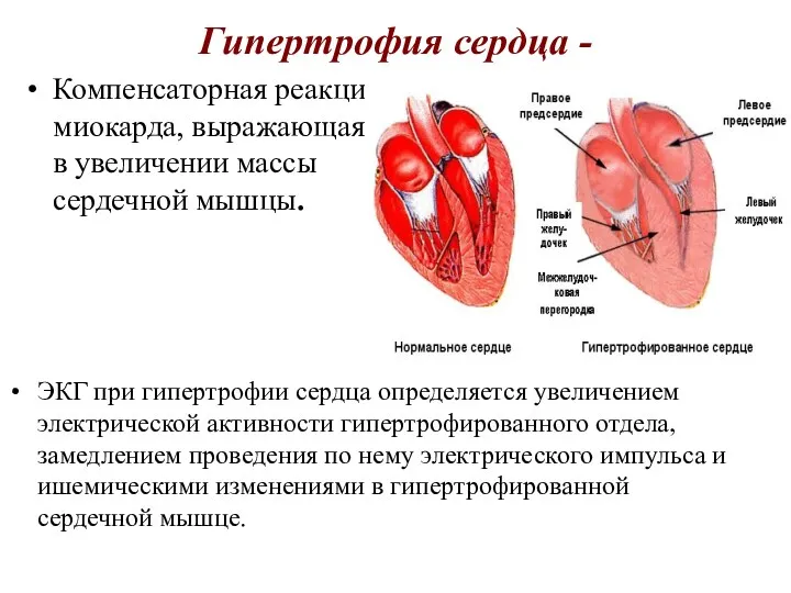 Гипертрофия сердца - Компенсаторная реакция миокарда, выражающаяся в увеличении массы