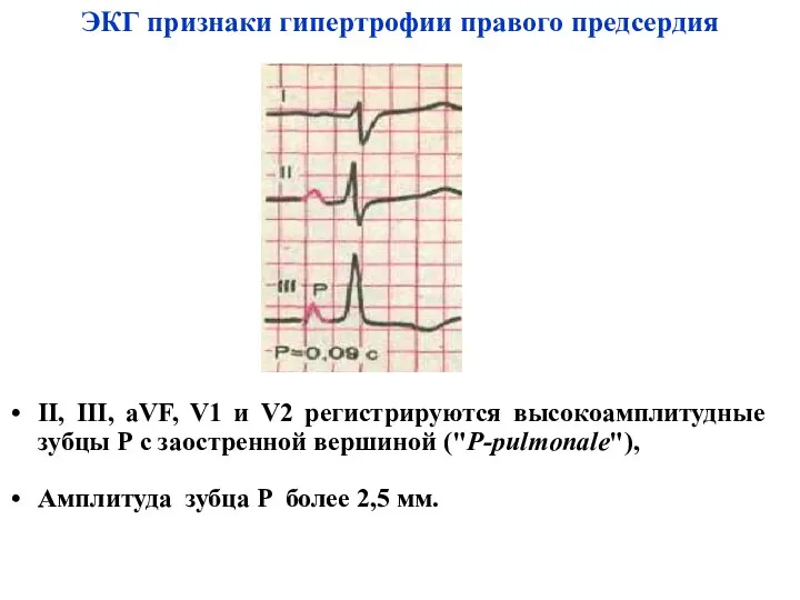 ЭКГ признаки гипертрофии правого предсердия II, III, aVF, V1 и