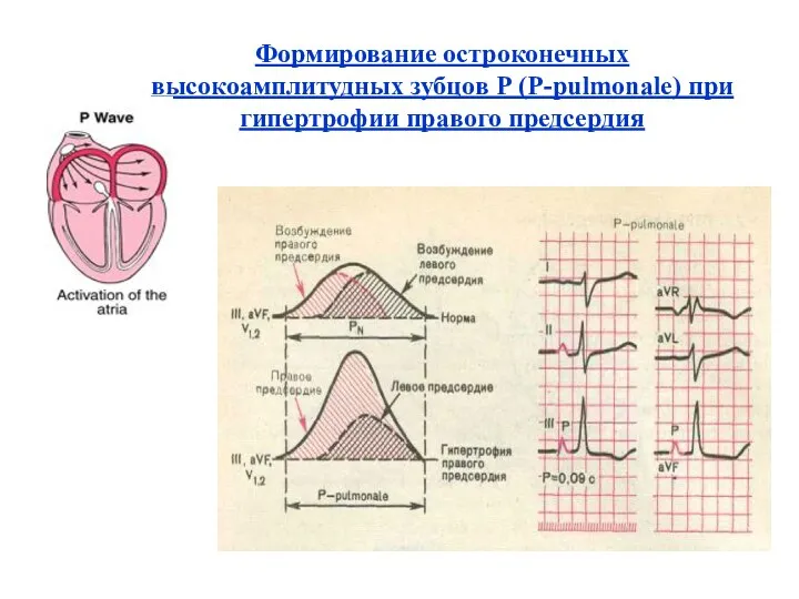 Формирование остроконечных высокоамплитудных зубцов Р (Р-pulmonale) при гипертрофии правого предсердия