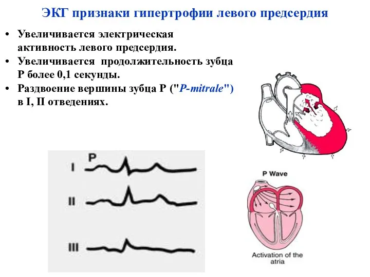 ЭКГ признаки гипертрофии левого предсердия Увеличивается электрическая активность левого предсердия.