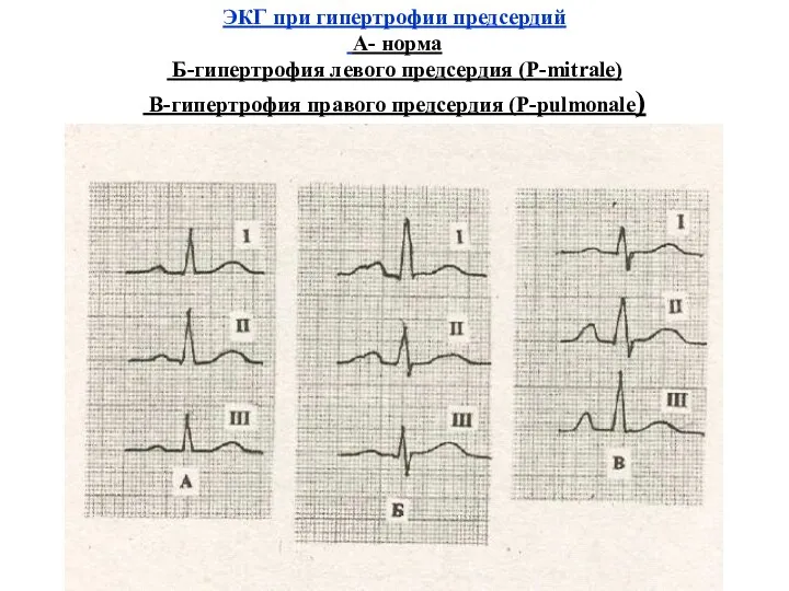 ЭКГ при гипертрофии предсердий А- норма Б-гипертрофия левого предсердия (Р-mitrale) В-гипертрофия правого предсердия (P-pulmonale)