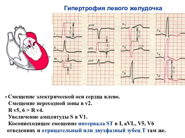 Гипертрофия левого желудочка Смещение электрической оси сердца влево. Смещение переходной