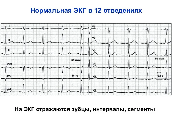 Нормальная ЭКГ в 12 отведениях На ЭКГ отражаются зубцы, интервалы, сегменты