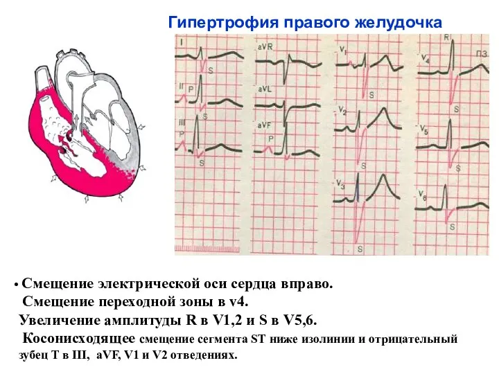 Гипертрофия правого желудочка Смещение электрической оси сердца вправо. Смещение переходной