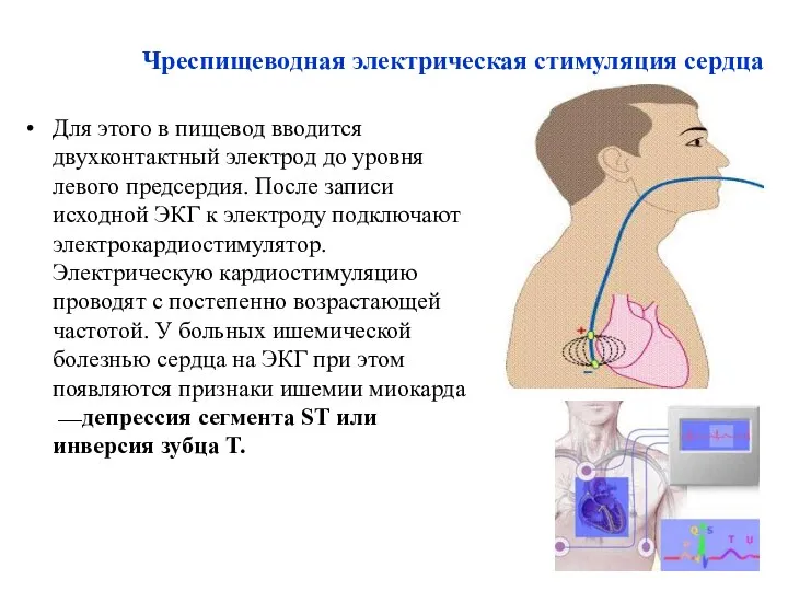 Чреспищеводная электрическая стимуляция сердца Для этого в пищевод вводится двухконтактный