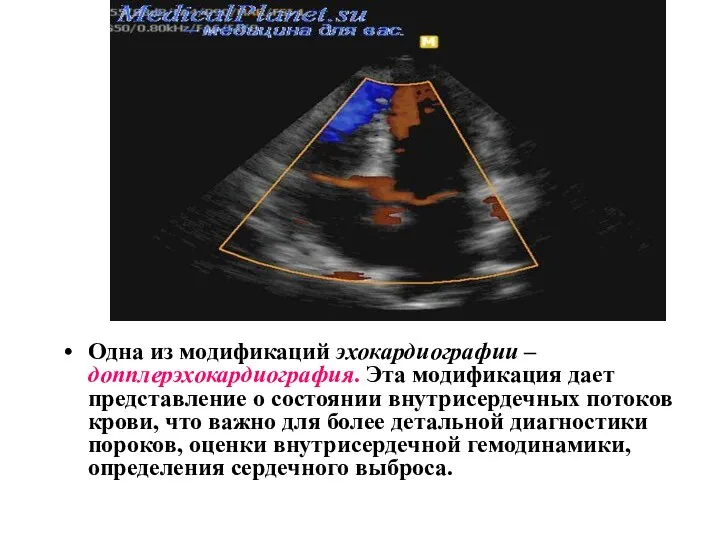 Одна из модификаций эхокардиографии – допплерэхокардиография. Эта модификация дает представление