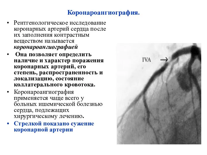 Коронароангиография. Рентгенологическое исследование коронарных артерий сердца после их заполнения контрастным