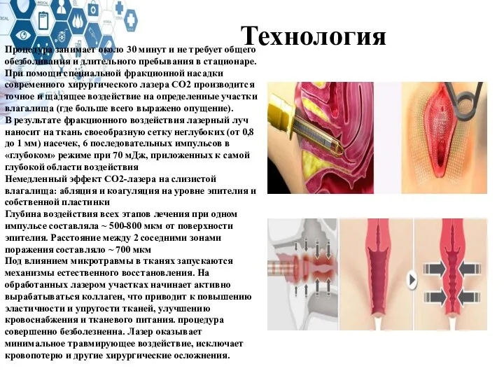 Технология Процедура занимает около 30 минут и не требует общего