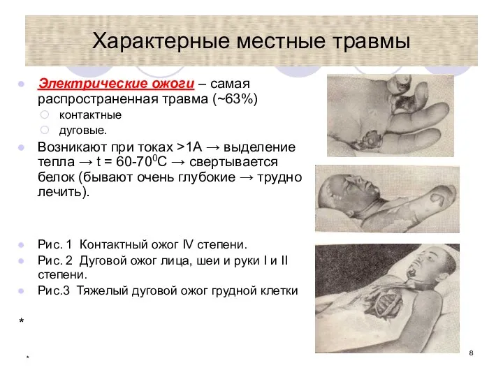 * Характерные местные травмы Электрические ожоги – самая распространенная травма