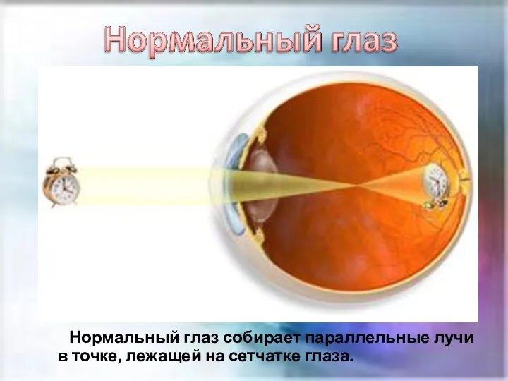 Нормальный глаз собирает параллельные лучи в точке, лежащей на сетчатке глаза.