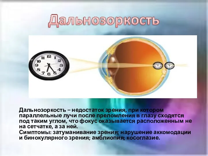 Дальнозоркость – недостаток зрения, при котором параллельные лучи после преломления