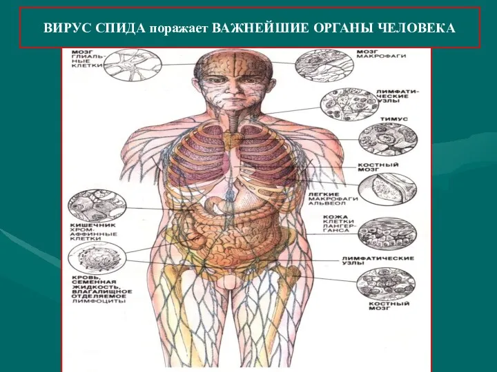 ВИРУС СПИДА поражает ВАЖНЕЙШИЕ ОРГАНЫ ЧЕЛОВЕКА