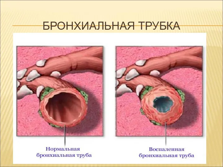 БРОНХИАЛЬНАЯ ТРУБКА