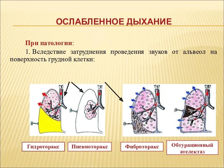 ОСЛАБЛЕННОЕ ДЫХАНИЕ При патологии: 1. Вследствие затруднения проведения звуков от