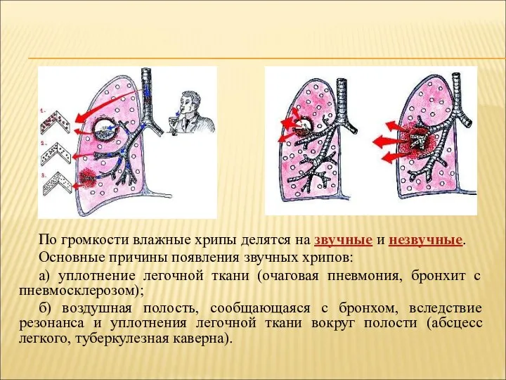 По громкости влажные хрипы делятся на звучные и незвучные. Основные