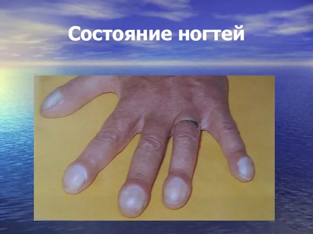 Состояние ногтей