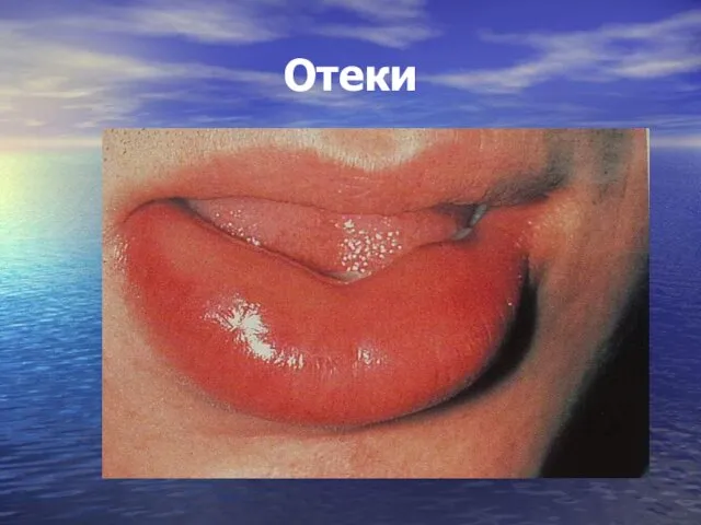 Отеки