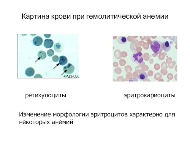 Картина крови при гемолитической анемии ретикулоциты эритрокариоциты Изменение морфологии эритроцитов характерно для некоторых анемий