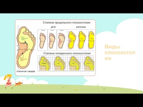 Виды плоскостопия