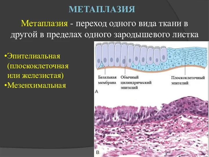 МЕТАПЛАЗИЯ Метаплазия - переход одного вида ткани в другой в пределах одного зародышевого