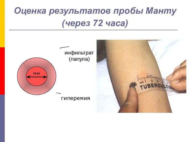 Оценка результатов пробы Манту (через 72 часа) инфильтрат (папула) гиперемия мм