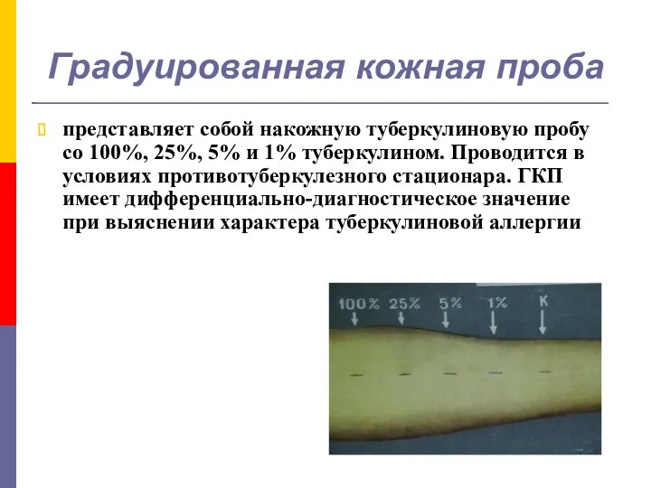Градуированная кожная проба представляет собой накожную туберкулиновую пробу со 100%, 25%, 5% и