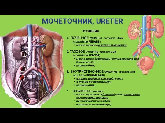 МОЧЕТОЧНИК, URETER СУЖЕНИЯ: 1. ПОЧЕЧНОЕ сужение- просвет 2– 4 мм