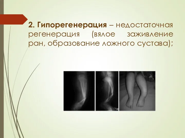 2. Гипорегенерация – недостаточная регенерация (вялое заживление ран, образование ложного сустава);
