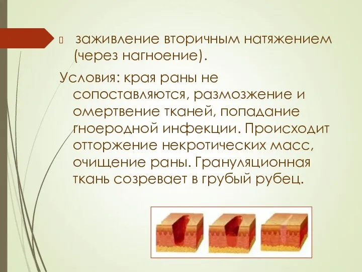 заживление вторичным натяжением (через нагноение). Условия: края раны не сопоставляются,