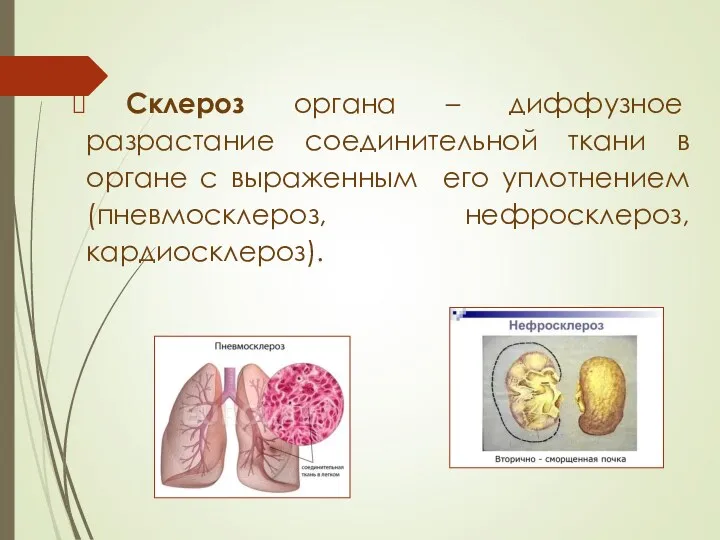Склероз органа – диффузное разрастание соединительной ткани в органе с выраженным его уплотнением (пневмосклероз, нефросклероз, кардиосклероз).