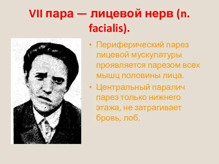 VII пара — лицевой нерв (n. facialis). Периферический парез лицевой мускулатуры проявляется парезом
