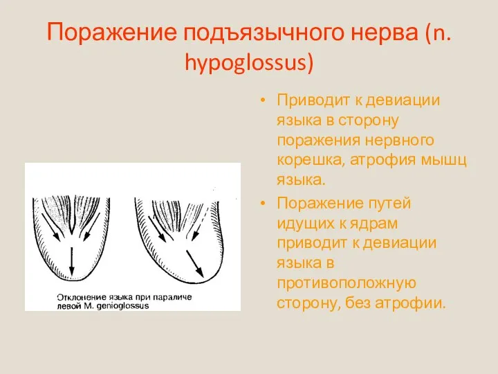Поражение подъязычного нерва (n. hypoglossus) Приводит к девиации языка в