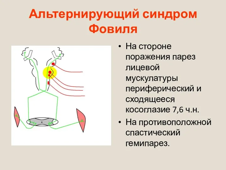 Альтернирующий синдром Фовиля На стороне поражения парез лицевой мускулатуры периферический