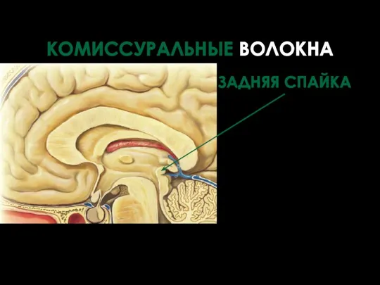 ЗАДНЯЯ СПАЙКА КОМИССУРАЛЬНЫЕ ВОЛОКНА находится над входом в водопровод среднего мозга, т.е. в