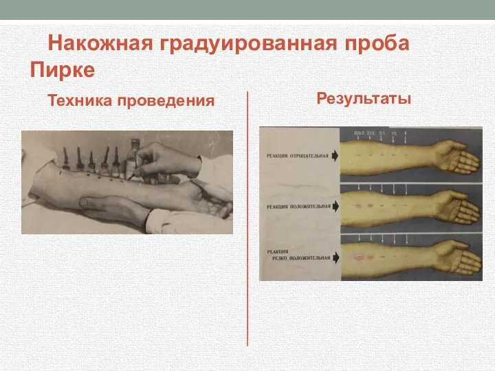 Накожная градуированная проба Пирке Техника проведения Результаты