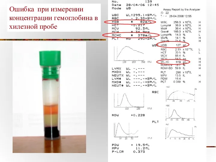 Ошибка при измерении концентрации гемоглобина в хилезной пробе