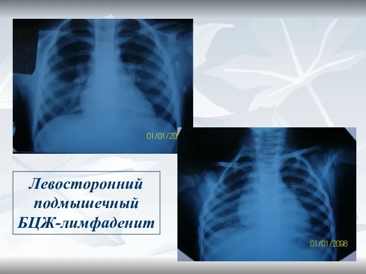 Левосторонний подмышечный БЦЖ-лимфаденит