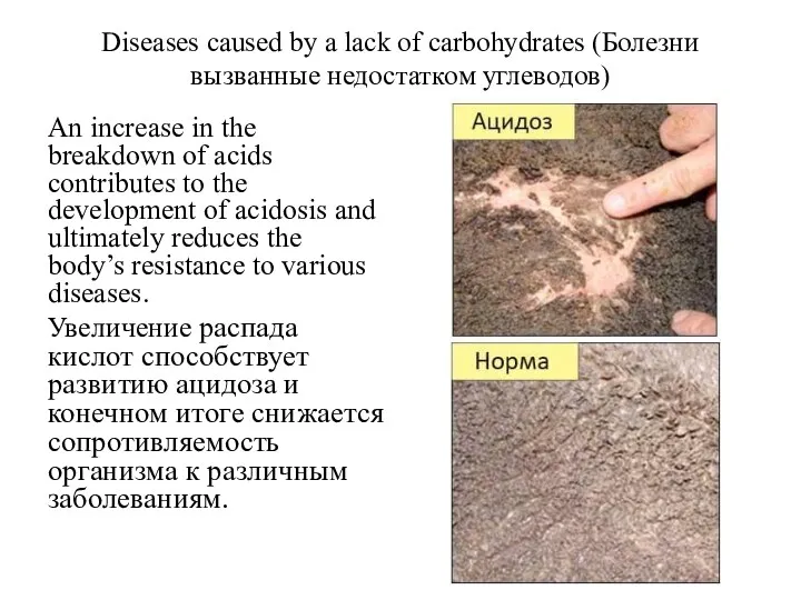 Diseases caused by a lack of carbohydrates (Болезни вызванные недостатком