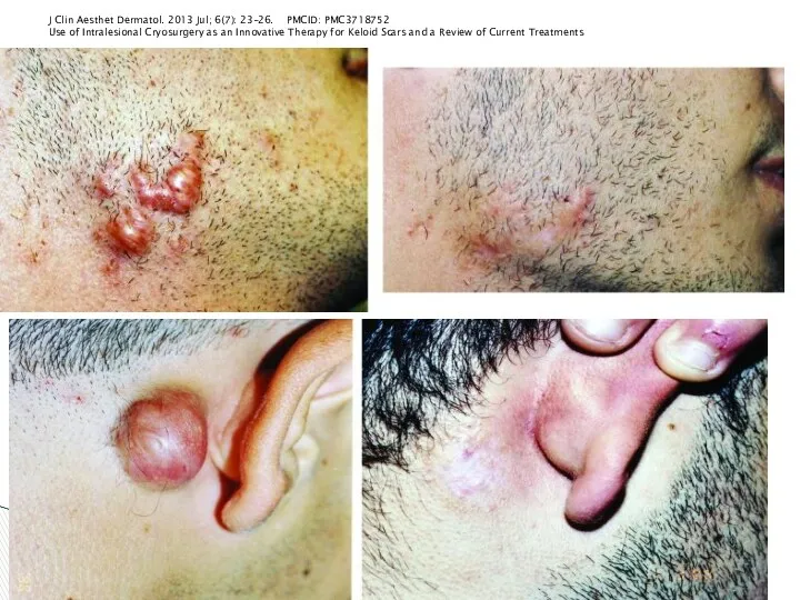 J Clin Aesthet Dermatol. 2013 Jul; 6(7): 23–26. PMCID: PMC3718752