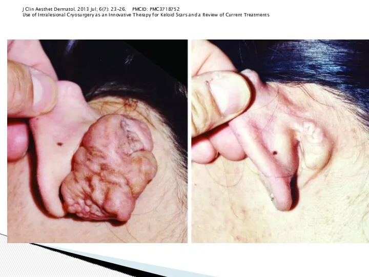 J Clin Aesthet Dermatol. 2013 Jul; 6(7): 23–26. PMCID: PMC3718752