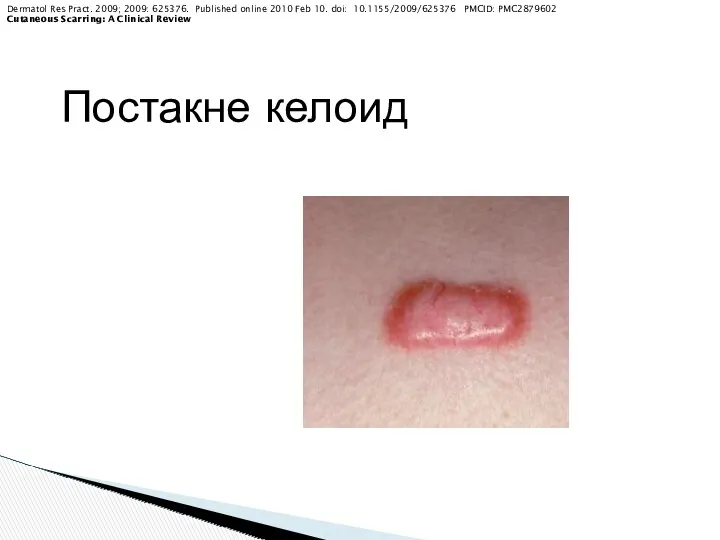 Постакне келоид Dermatol Res Pract. 2009; 2009: 625376. Published online