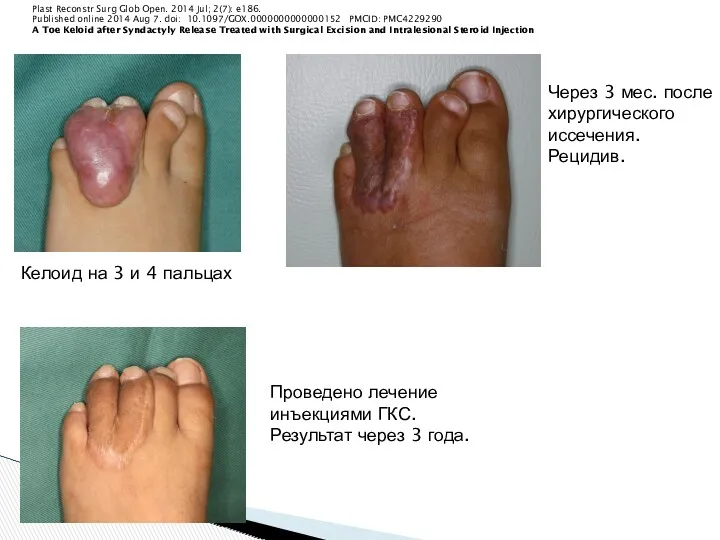 Plast Reconstr Surg Glob Open. 2014 Jul; 2(7): e186. Published