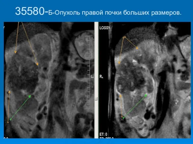 35580-Б-Опухоль правой почки больших размеров.