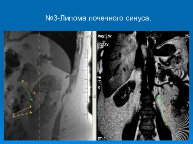 №3-Липома почечного синуса.